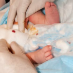 Circumcision